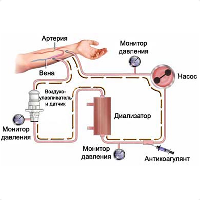 Диализ схема проведения
