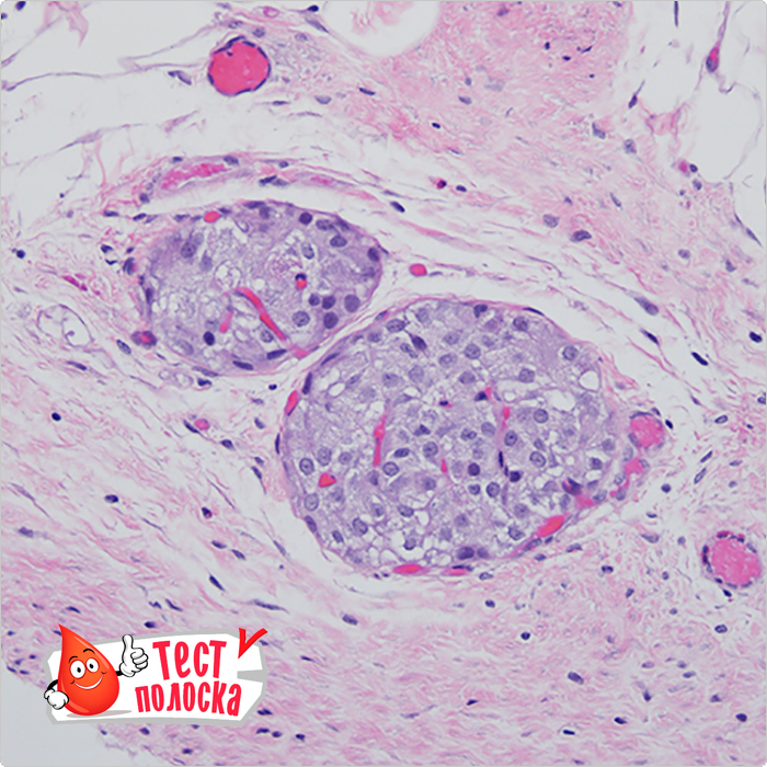 На этом снимке показаны трансплантированные островки (темно-фиолетовые) и кровеносные сосуды (красные/темно-розовые области - это клетки крови внутри кровеносных сосудов).